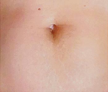 Green Peel Herbal Peeling Treatment 8 After