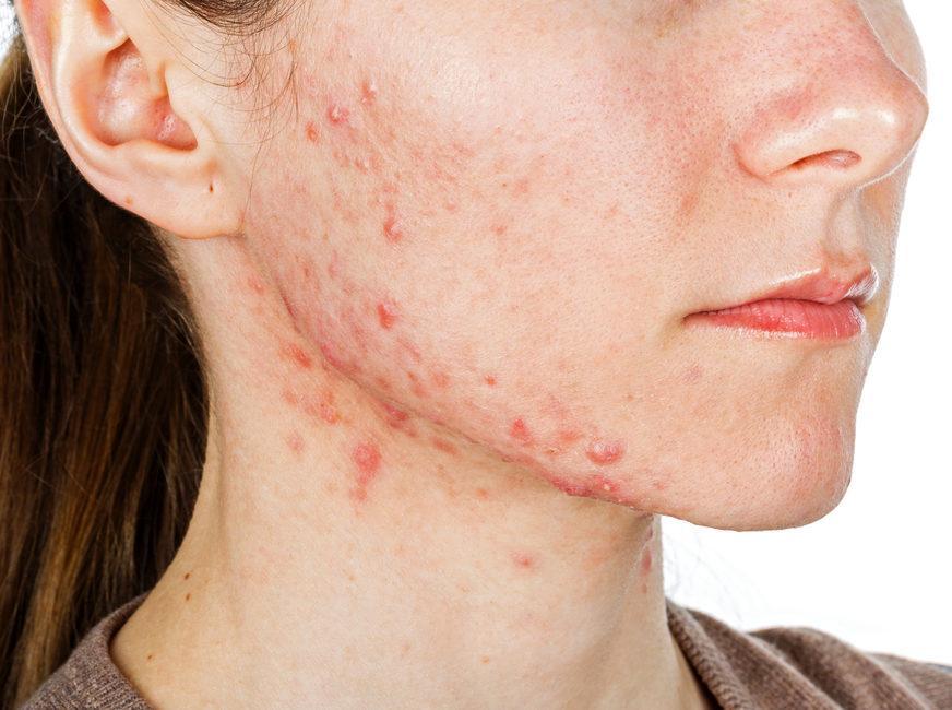 Acne Treatment 1 null
