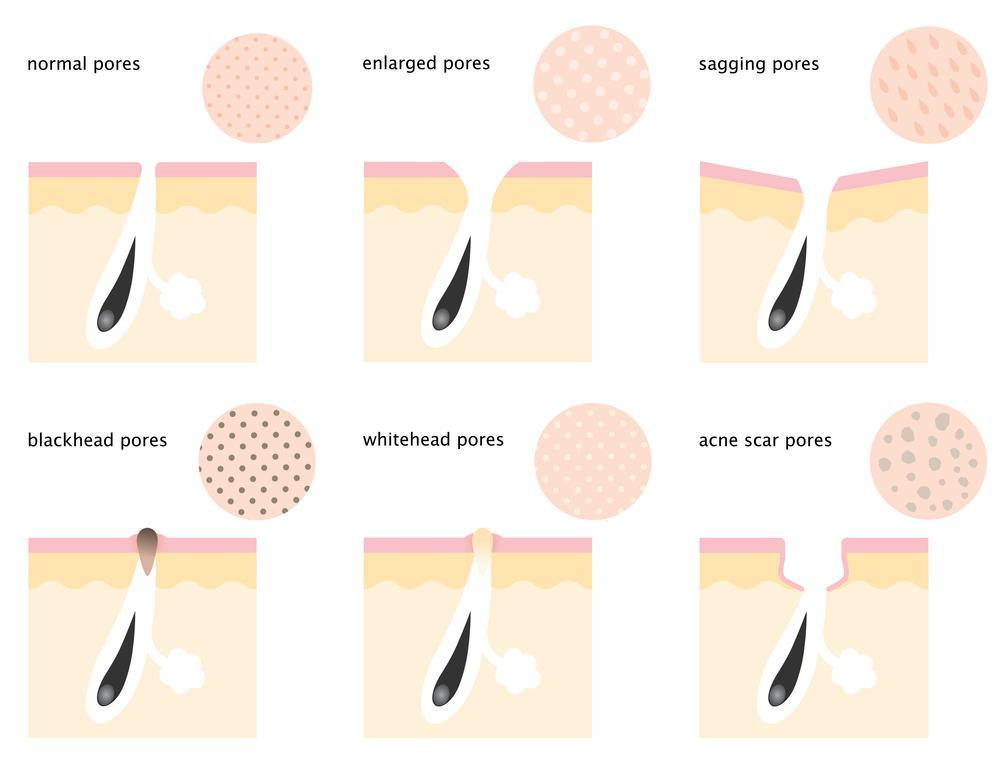 Acne Treatment 2 null