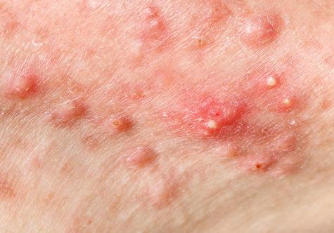 Acne Treatment 5 null