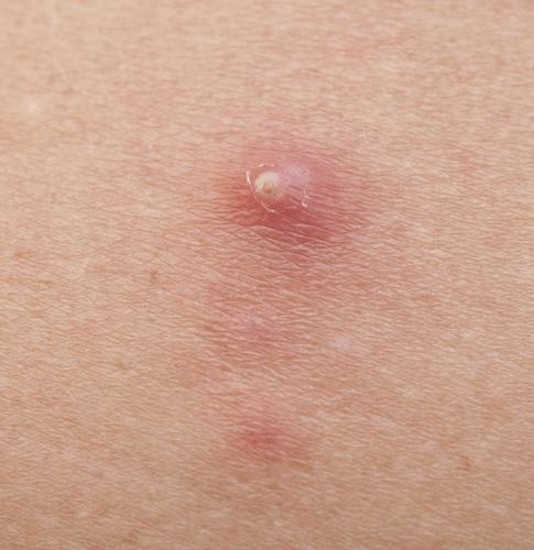 Acne Treatment 4 null