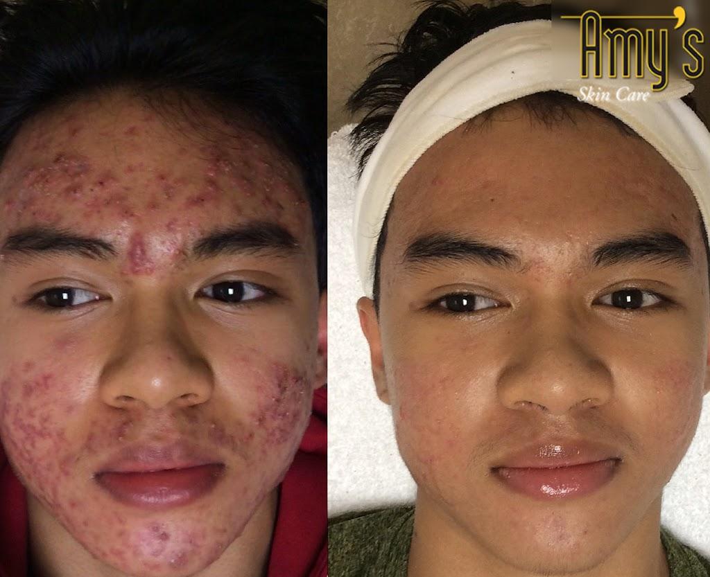 acne-treatment-houston